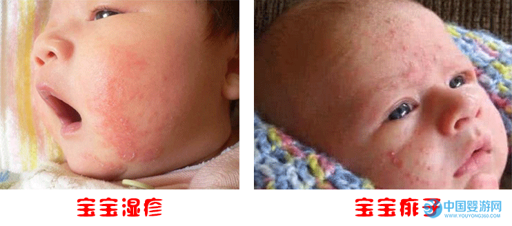 宝宝湿疹和痱子的区别