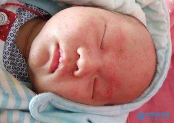 宝宝湿疹的病因和复发原因