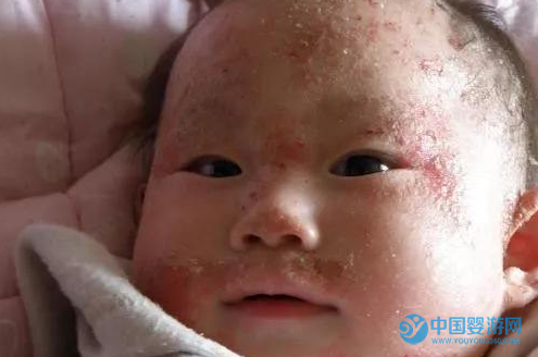 预防宝宝皮肤过敏，你还可以这样做 宝宝皮肤过敏症状 预防宝宝皮肤过敏的方法 宝宝皮肤过敏怎么办