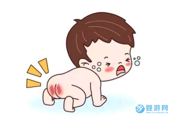 崔玉涛：夏季如何预防宝宝红屁屁 引起宝宝红屁屁的原因 宝宝尿布疹的原因 护臀膏能治疗尿布疹吗 护臀膏的作用有哪些