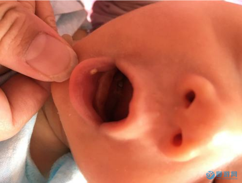 新生儿鹅口疮是怎么回事？怎么解决 宝宝鹅口疮病因是什么 如何辨别宝宝患鹅口疮 宝宝鹅口疮护理方法