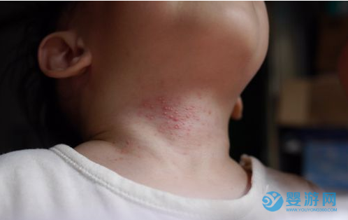 宝宝湿疹如何预防及治疗？痱子和湿疹有什么不同？ 【干货】湿疹和痱子的五大区别之后，护理变得很简单3