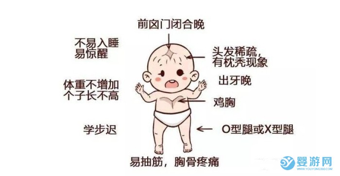 宝宝佝偻病是怎么回事？有什么表现？又该如何预防？ 佝偻病是怎么回事 造成佝偻病的原因 佝偻病有什么表现 如何预防佝偻病1